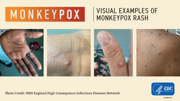 monkeypox visuals