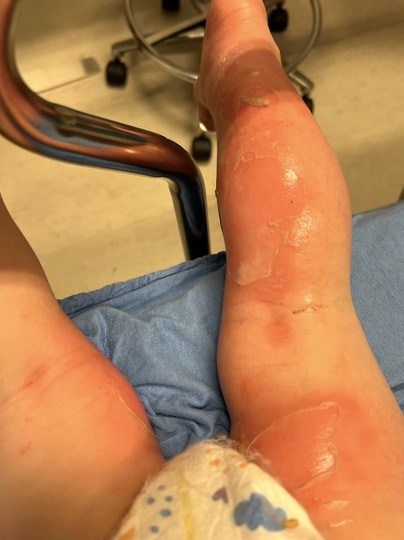 severe burns on infants legs